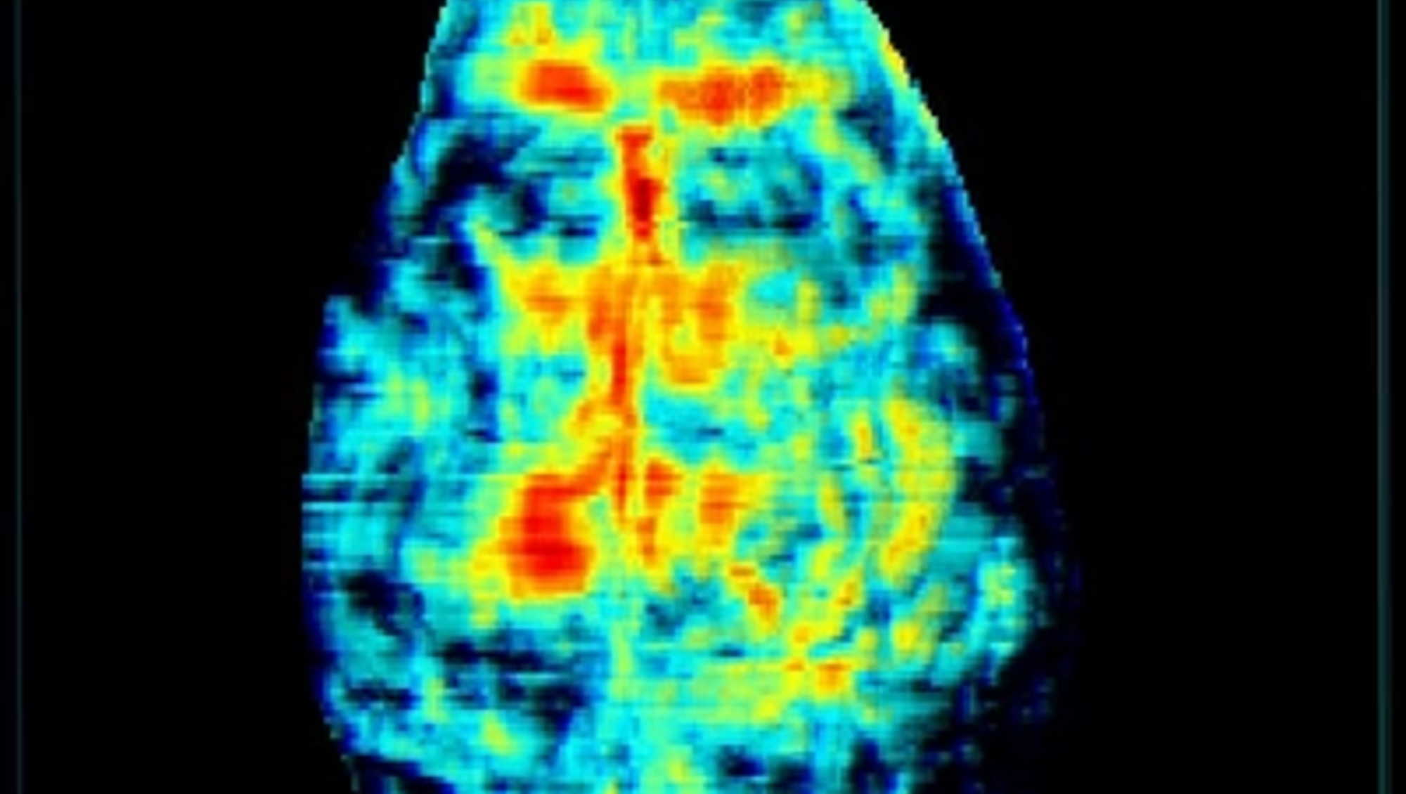 3D Rendered Photoacoustic Image of Mouse Cerebral Blood Flow on Vevo F2 System; image FUJIFILM VisualSonics