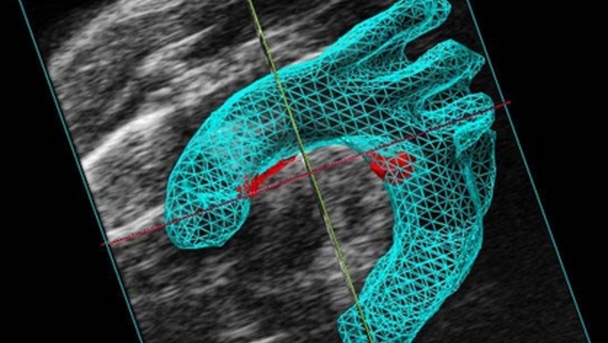 3D Volume Reconstruction of Mouse Aortic Arch (blue) with Atherosclerotic Plaques (in red), Vevo F2 System; image by FUJIFILM VisualSonics