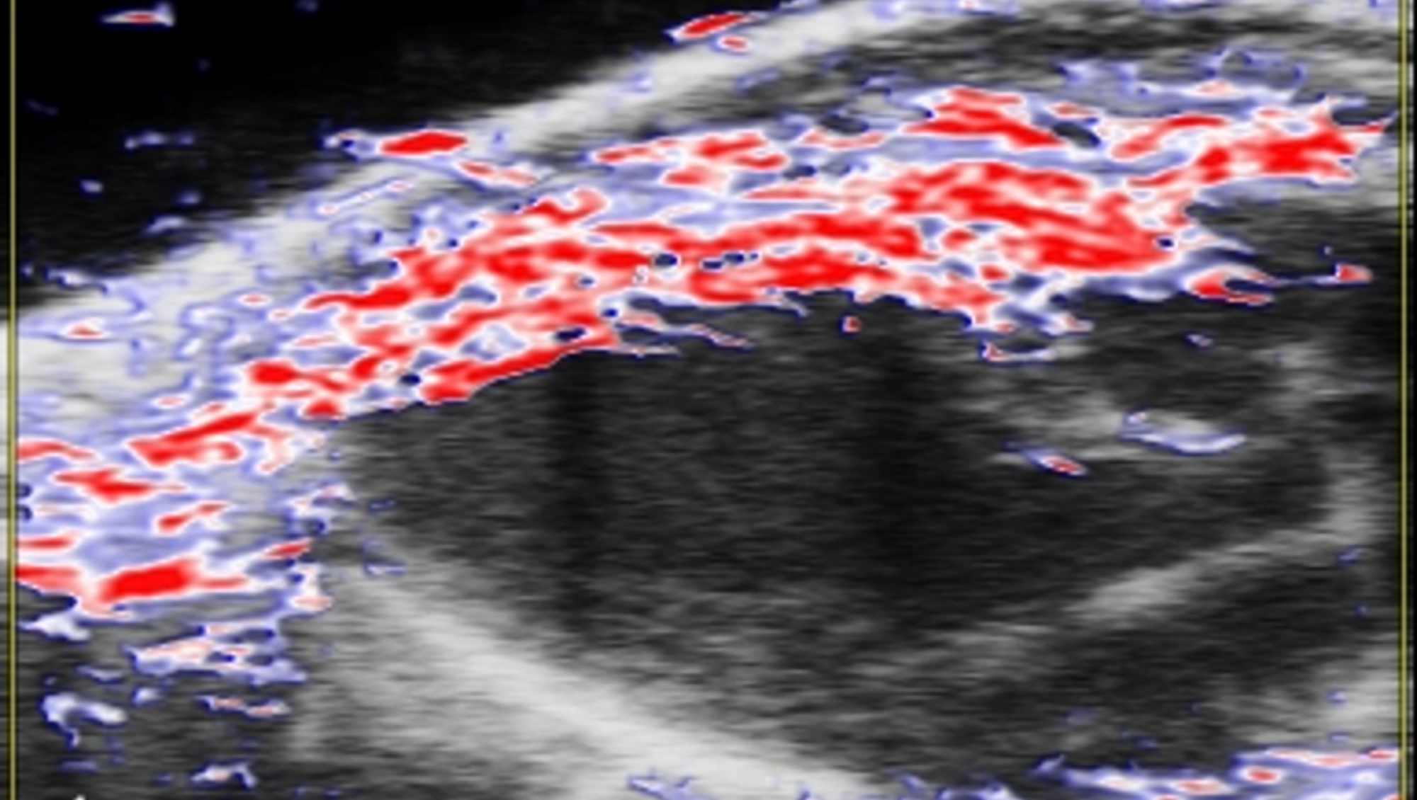 Oxygen Saturation in Myocardium, Ultrasound (greyscale), Photoacoustic (red, white, blue), Long Axis of Mouse Heart Left Ventricle on Vevo F2 System; image: FUJIFILM VisualSonics