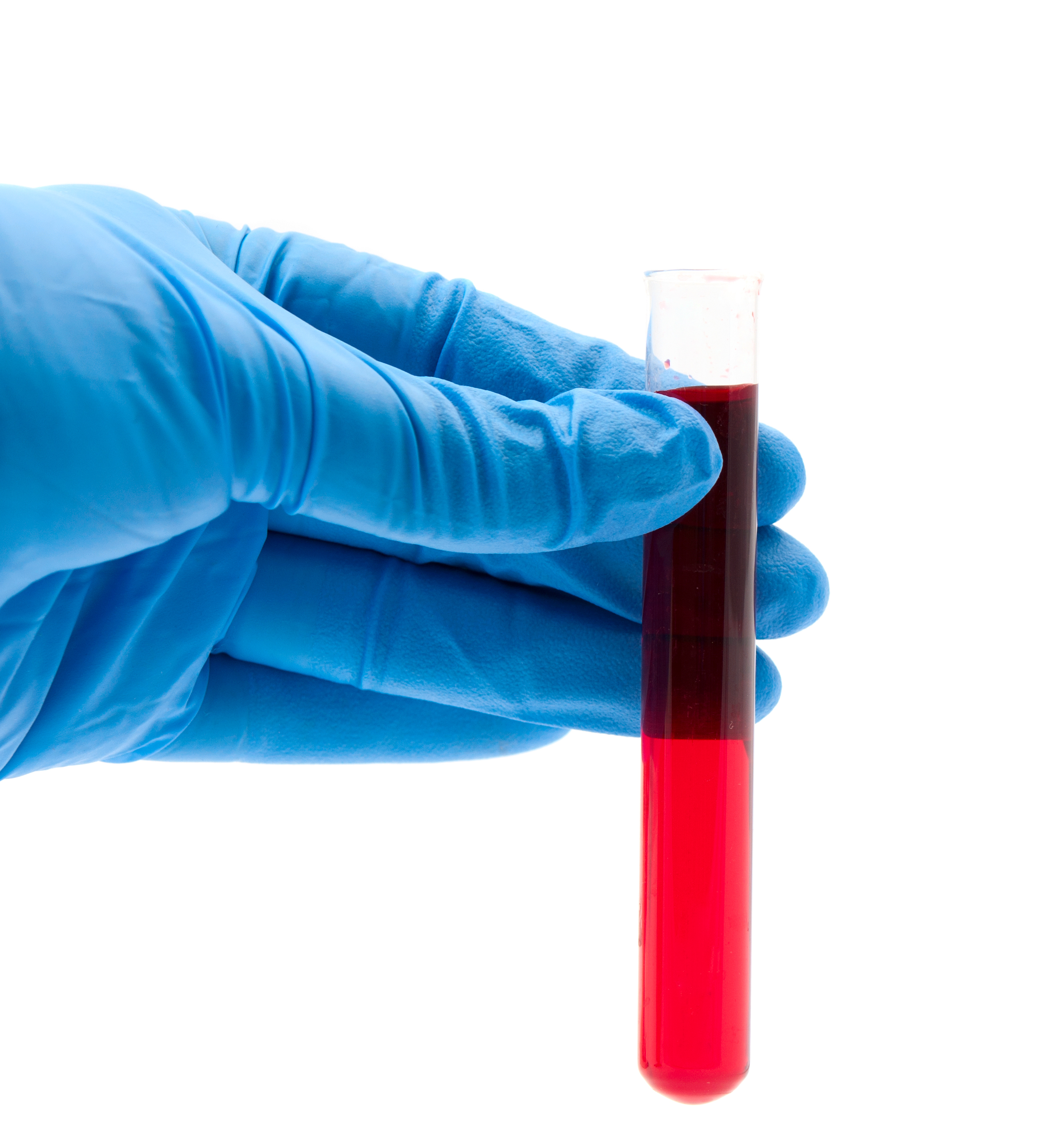 The researchers’ hypothesis is that acute myeloid leukaemia returns in the patients due to the leukaemia stem cells in the body, as it is often not possible to remove them using chemotherapy. The researchers’ hypothesis is that acute myeloid leukaemia returns in the patients due to the leukaemia stem cells in the body, as it is often not possible to remove them using chemotherapy.