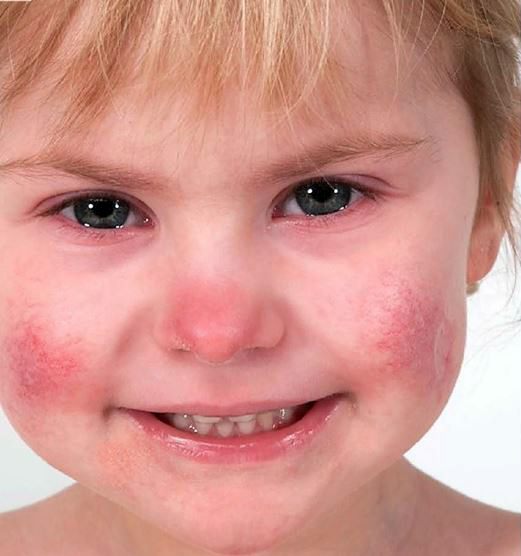 Pigen lider af sygdommen SAVI, fordi cellerne i hendes krop konstant frigiver molekyler, der giver betændelse. Det resulterer i kraftig hudeksem, problemer med lungefunktion og nedsat vækst. Foto: National Institutes of Health Pigen lider af sygdommen SAVI, fordi cellerne i hendes krop konstant frigiver molekyler, der giver betændelse. Det resulterer i kraftig hudeksem, problemer med lungefunktion og nedsat vækst. Foto: National Institutes of Health